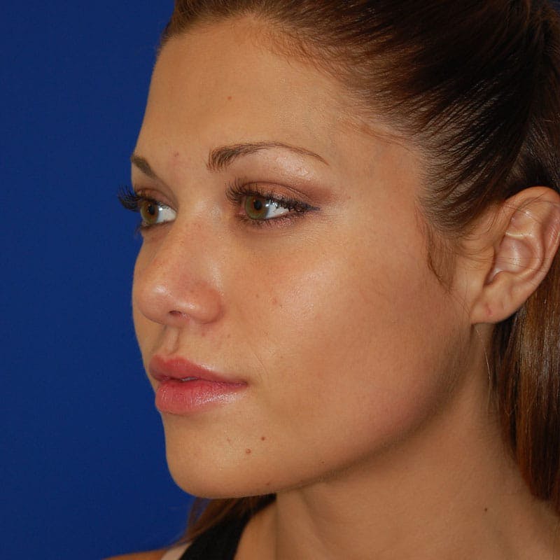 Revision Rhinoplasty Before & After Gallery - Patient 207501 - Image 5