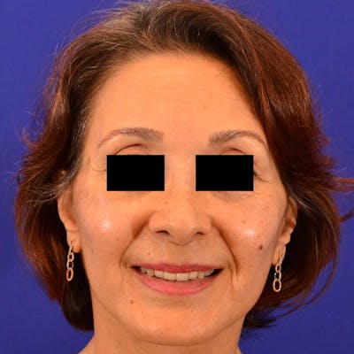Facelift & Necklift Before & After Gallery - Patient 711850 - Image 2