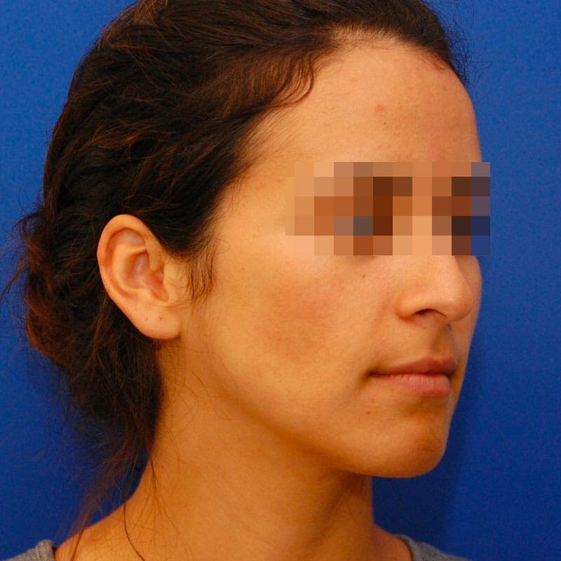 Ethnic Rhinoplasty Before & After Gallery - Patient 360276 - Image 3