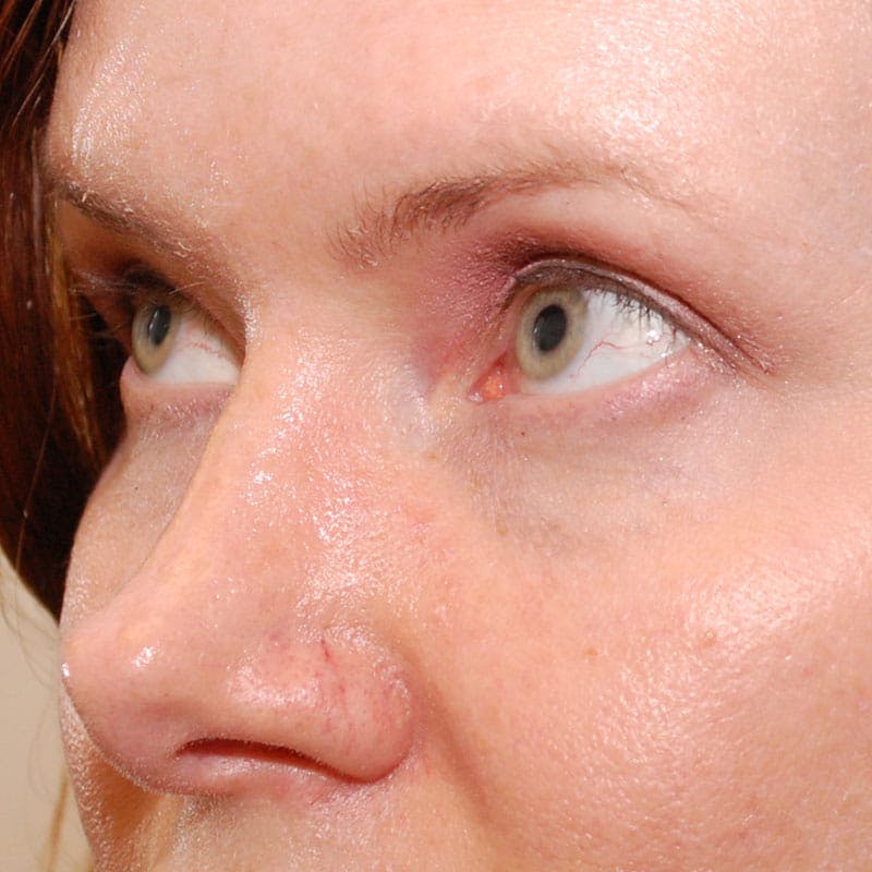 Upper Eyelid Surgery Before & After Gallery - Patient 547172 - Image 4