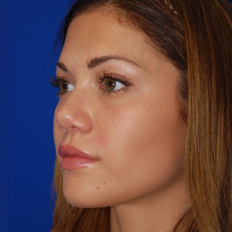 Revision Rhinoplasty Before & After Gallery - Patient 207501 - Image 6