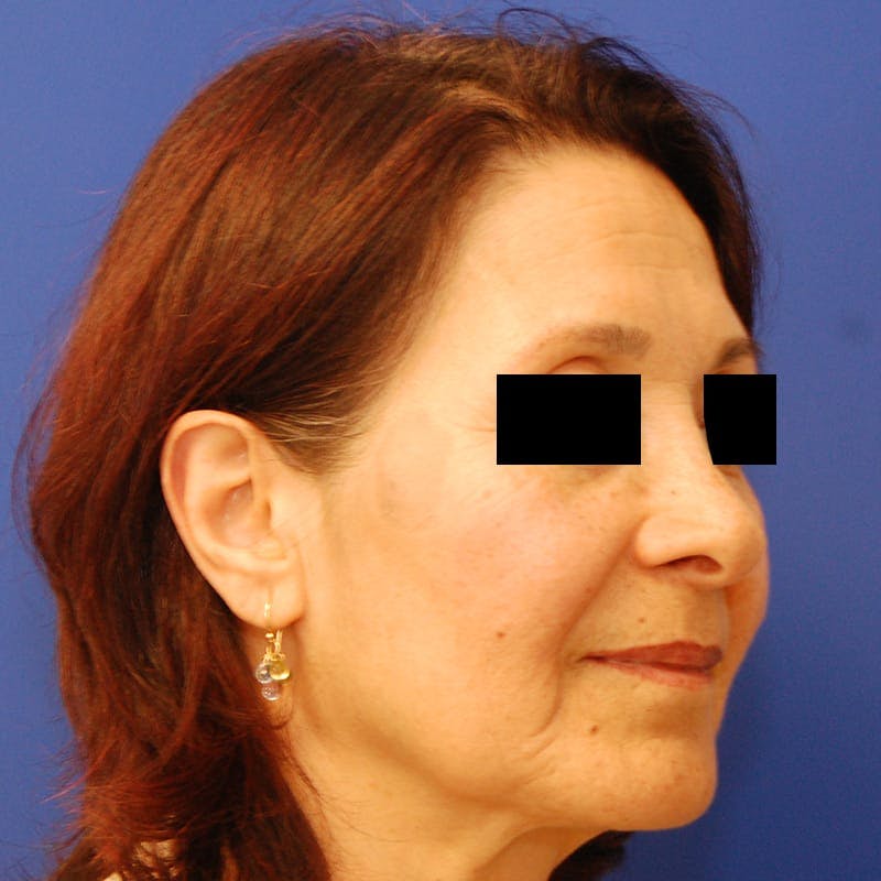 Facelift & Necklift Before & After Gallery - Patient 711850 - Image 3