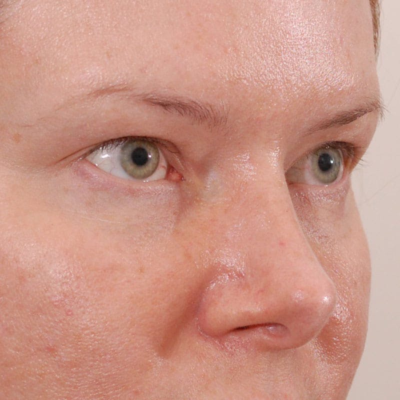 Upper Eyelid Surgery Before & After Gallery - Patient 547172 - Image 5