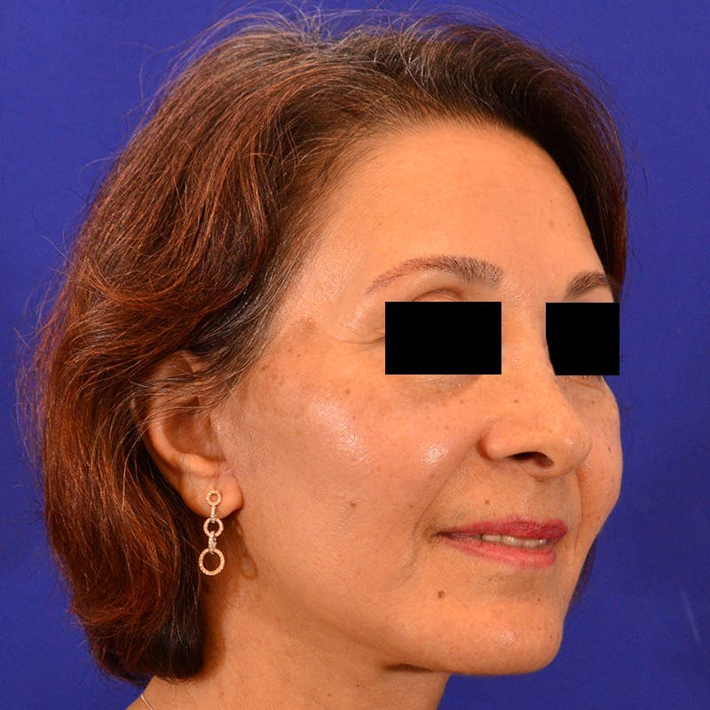 Facelift & Necklift Before & After Gallery - Patient 711850 - Image 4