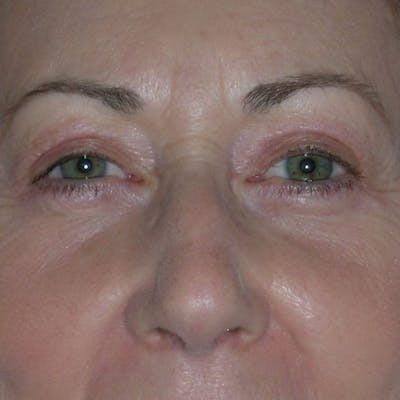 Lower Eyelid Surgery Before & After Gallery - Patient 390886 - Image 2