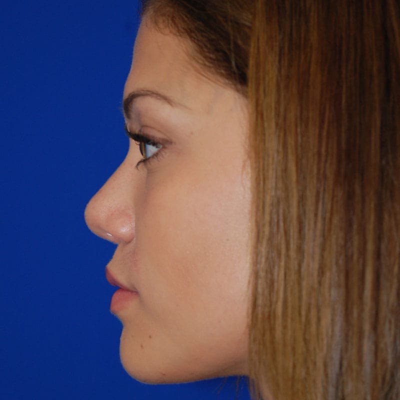 Revision Rhinoplasty Before & After Gallery - Patient 207501 - Image 2