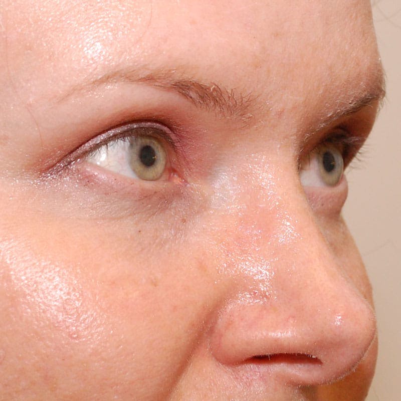 Upper Eyelid Surgery Before & After Gallery - Patient 547172 - Image 6