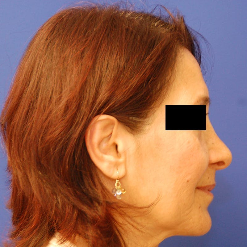 Facelift & Necklift Before & After Gallery - Patient 711850 - Image 5
