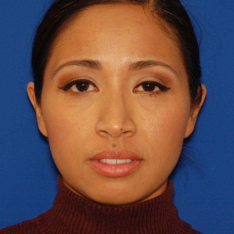 Ethnic Rhinoplasty Before & After Gallery - Patient 319140 - Image 3