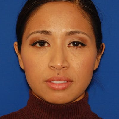 Ethnic Rhinoplasty Before & After Gallery - Patient 319140 - Image 1