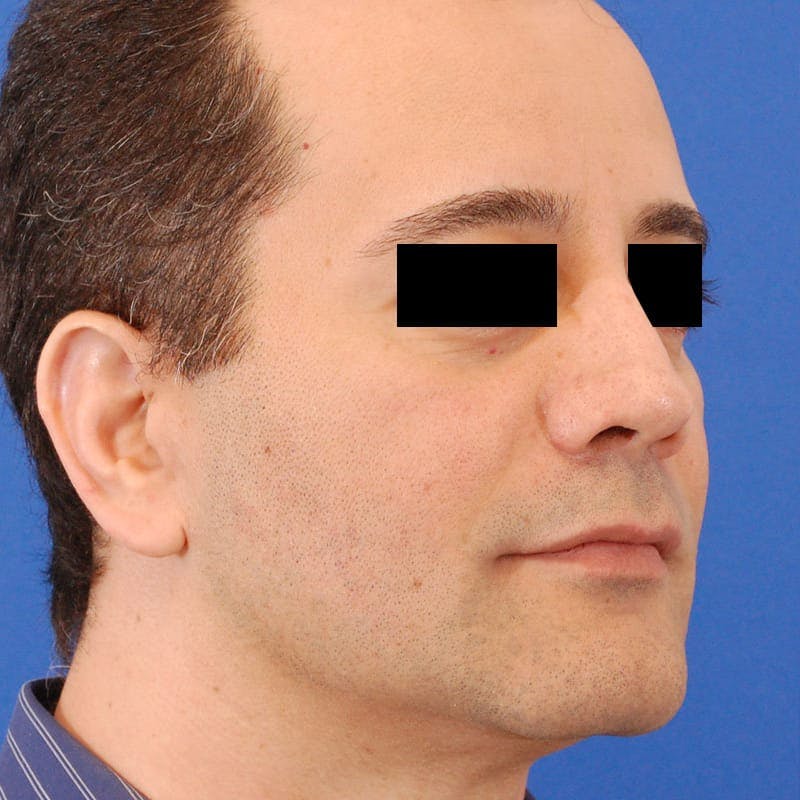 Male Rhinoplasty Before & After Gallery - Patient 175191 - Image 4