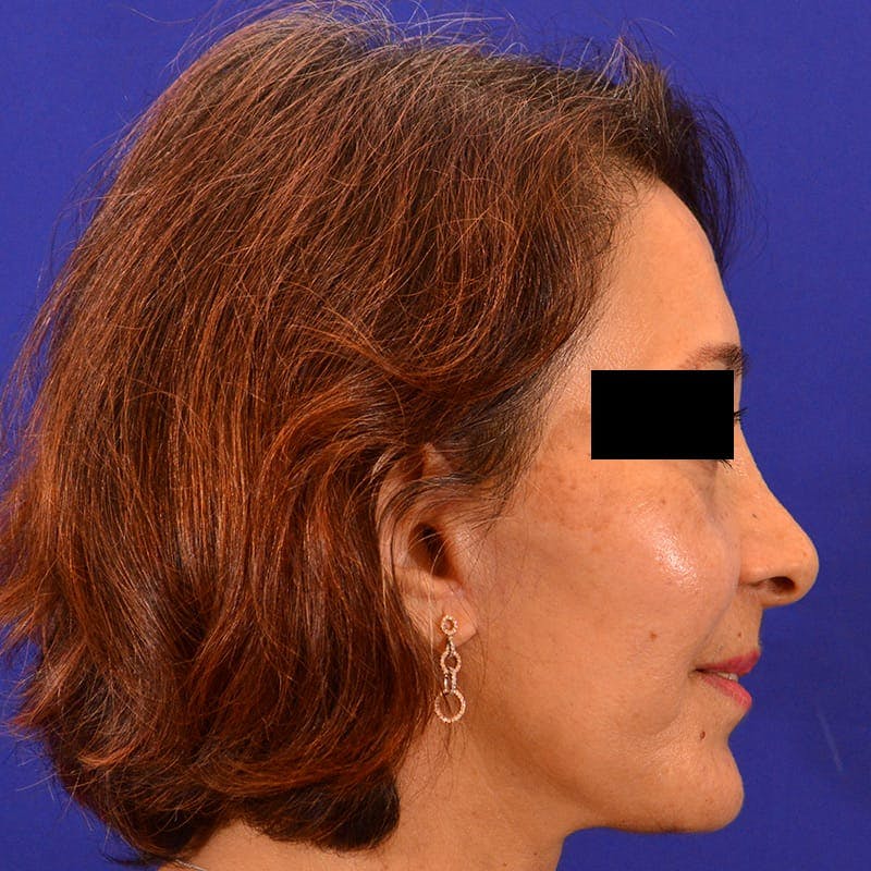 Facelift & Necklift Before & After Gallery - Patient 711850 - Image 6