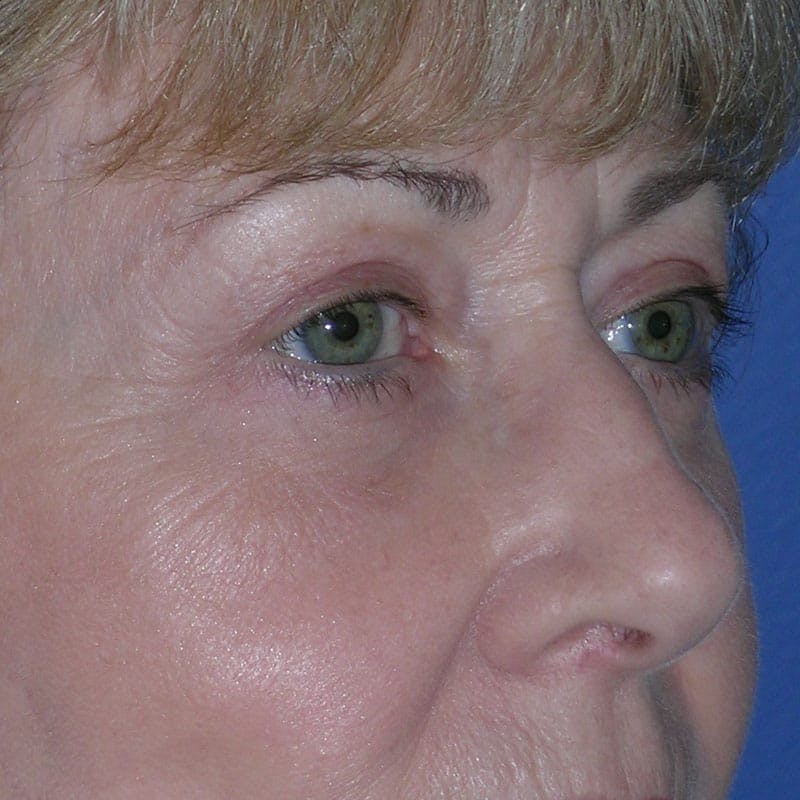 Lower Eyelid Surgery Before & After Gallery - Patient 390886 - Image 4