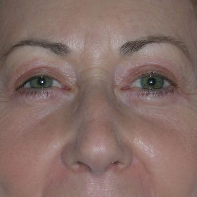 Upper Eyelid Surgery Before & After Gallery - Patient 350416 - Image 2