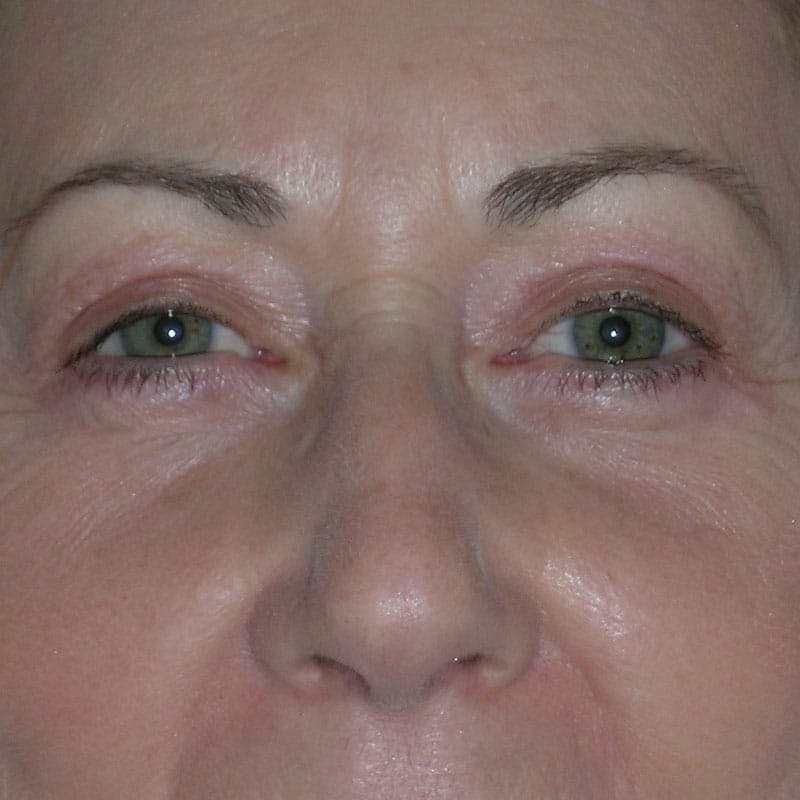 Upper Eyelid Surgery Before & After Gallery - Patient 350416 - Image 2
