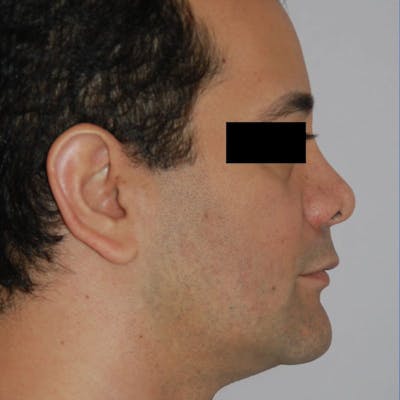 Male Rhinoplasty Before & After Gallery - Patient 175191 - Image 1