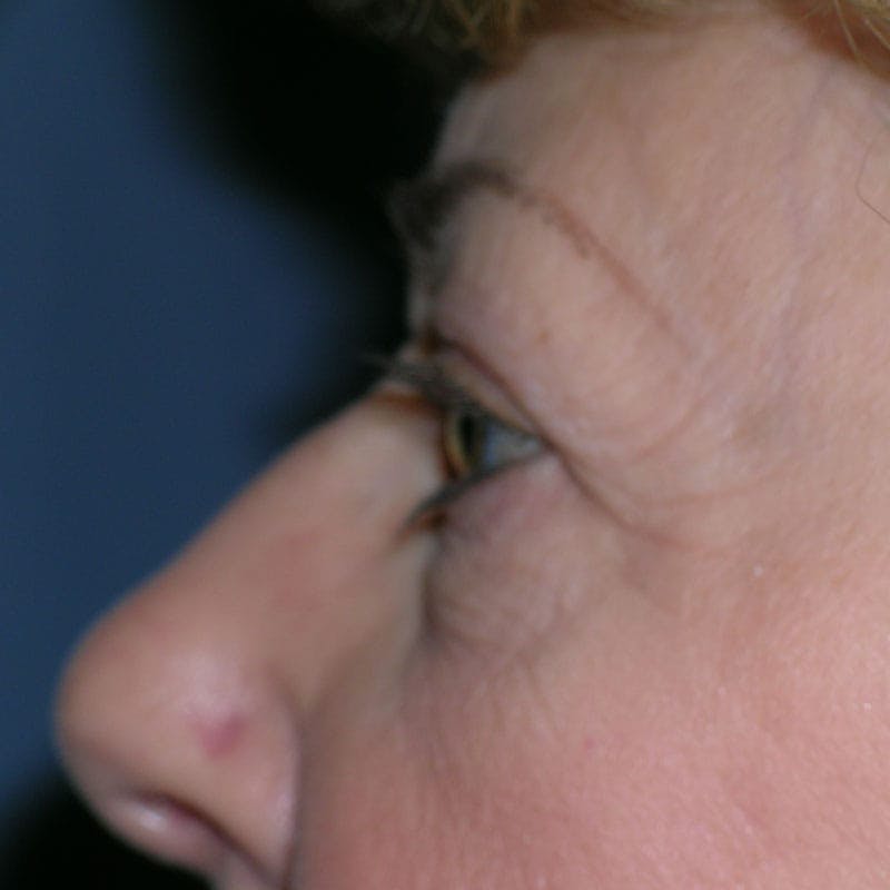 Lower Eyelid Surgery Before & After Gallery - Patient 390886 - Image 5