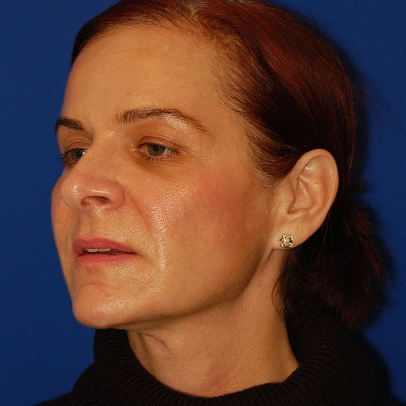 Revision Rhinoplasty Before & After Gallery - Patient 229910 - Image 5