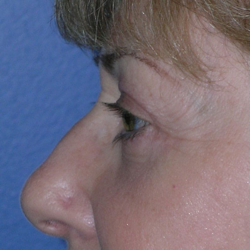 Lower Eyelid Surgery Before & After Gallery - Patient 390886 - Image 6