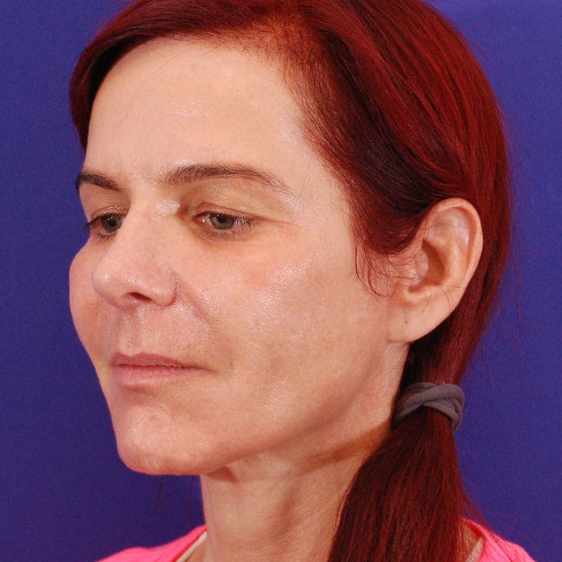 Revision Rhinoplasty Before & After Gallery - Patient 229910 - Image 6