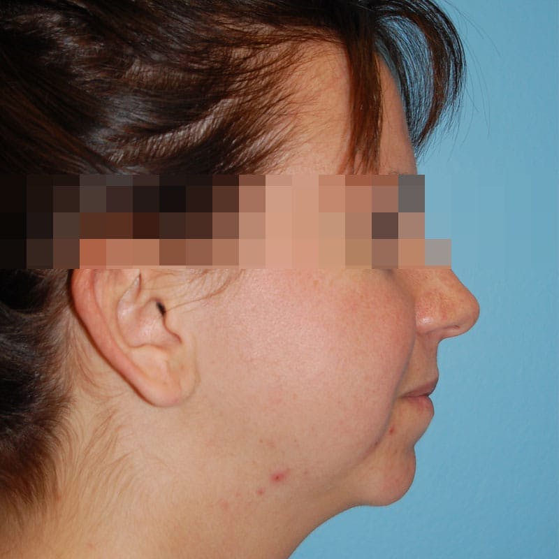 Chin Augmentation Before & After Gallery - Patient 200517 - Image 5
