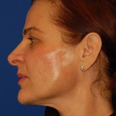 Revision Rhinoplasty Before & After Gallery - Patient 229910 - Image 1