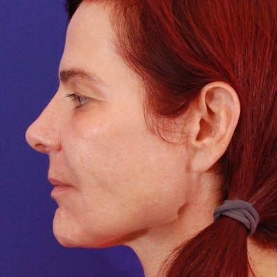Revision Rhinoplasty Before & After Gallery - Patient 229910 - Image 2