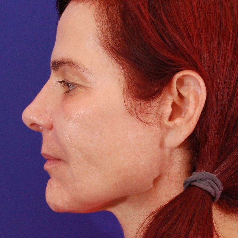 Revision Rhinoplasty Before & After Gallery - Patient 229910 - Image 6