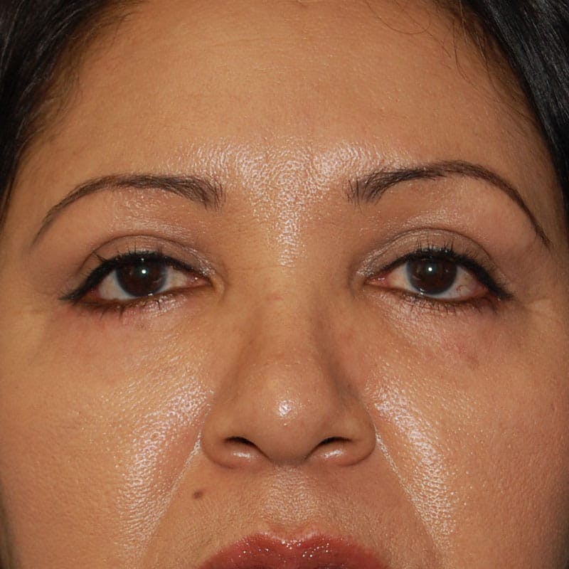 Lower Eyelid Surgery Before & After Gallery - Patient 195367 - Image 2