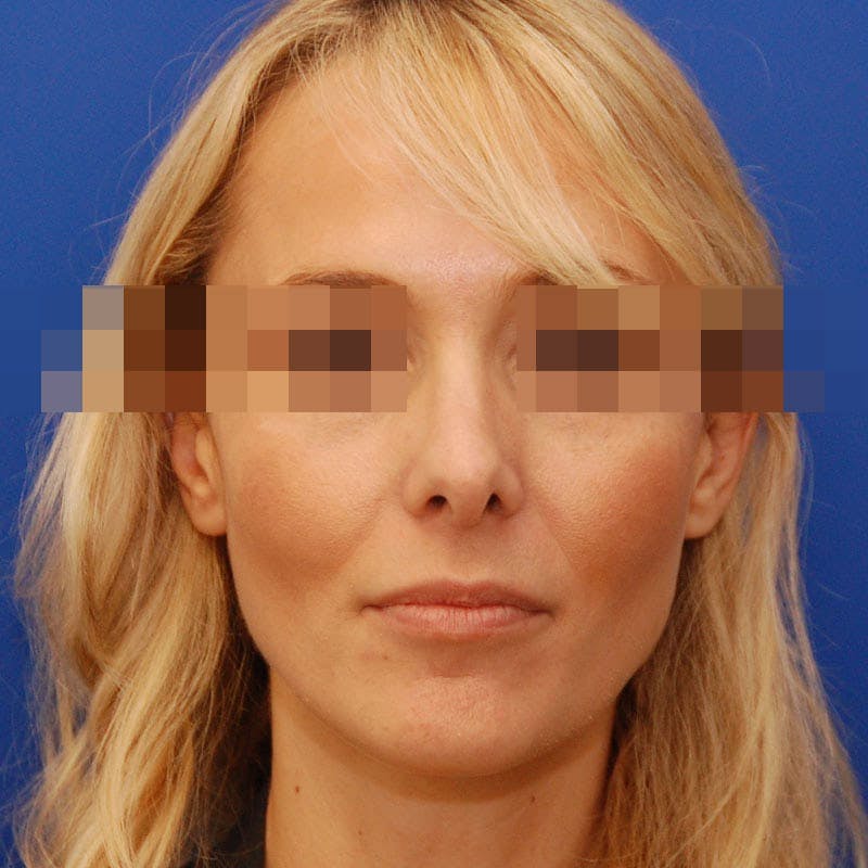 Revision Rhinoplasty Before & After Gallery - Patient 183705 - Image 3