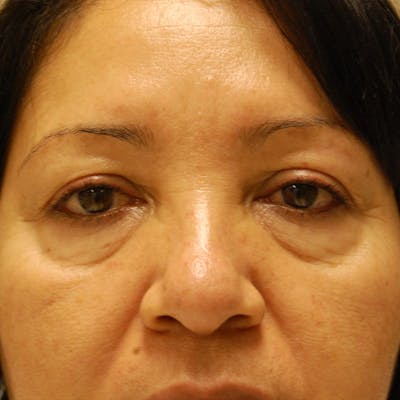 Upper Eyelid Surgery Before & After Gallery - Patient 386177 - Image 1