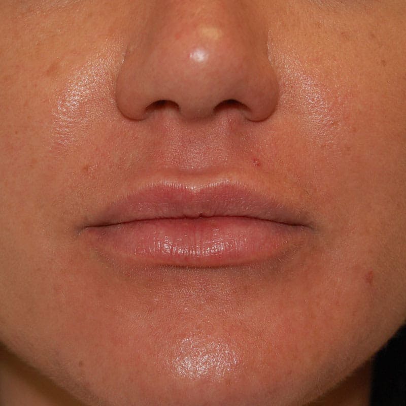 Lip Augmentation Before & After Gallery - Patient 163488 - Image 2