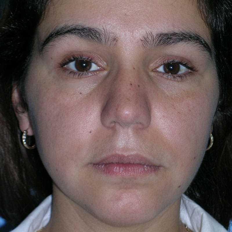 Ethnic Rhinoplasty Before & After Gallery - Patient 248424 - Image 4