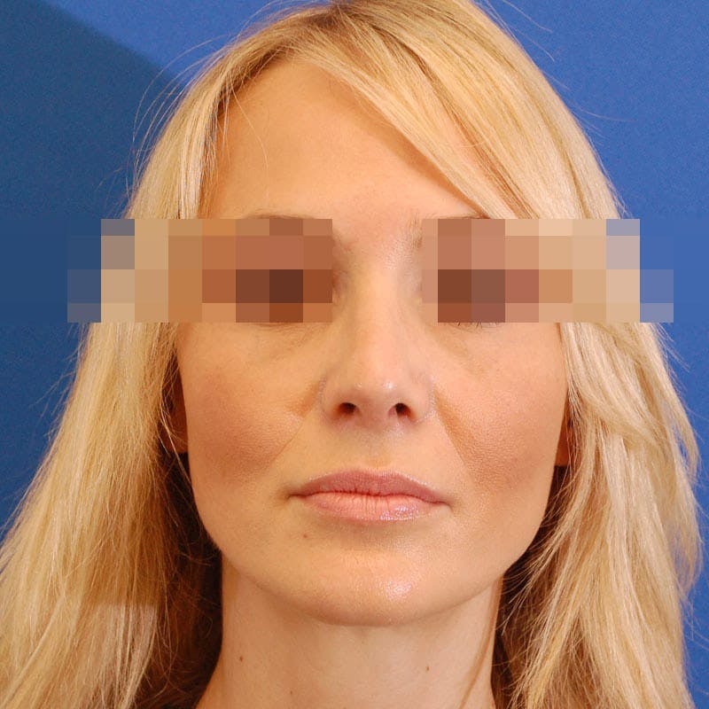 Revision Rhinoplasty Before & After Gallery - Patient 183705 - Image 4