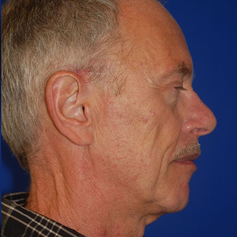 Facelift & Necklift Before & After Gallery - Patient 194480 - Image 5