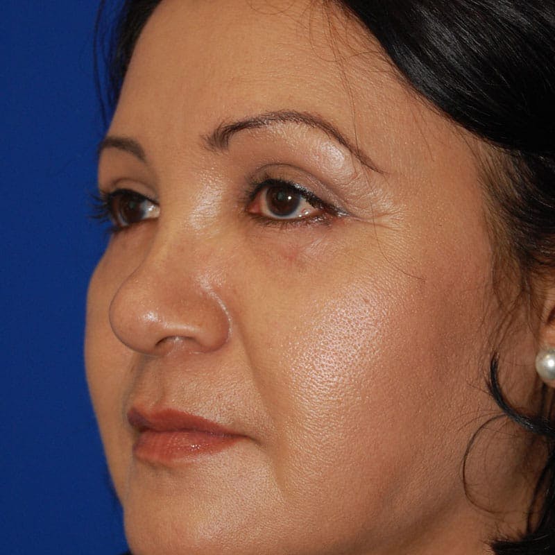 Lower Eyelid Surgery Before & After Gallery - Patient 195367 - Image 4