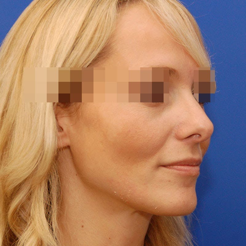 Revision Rhinoplasty Before & After Gallery - Patient 183705 - Image 5