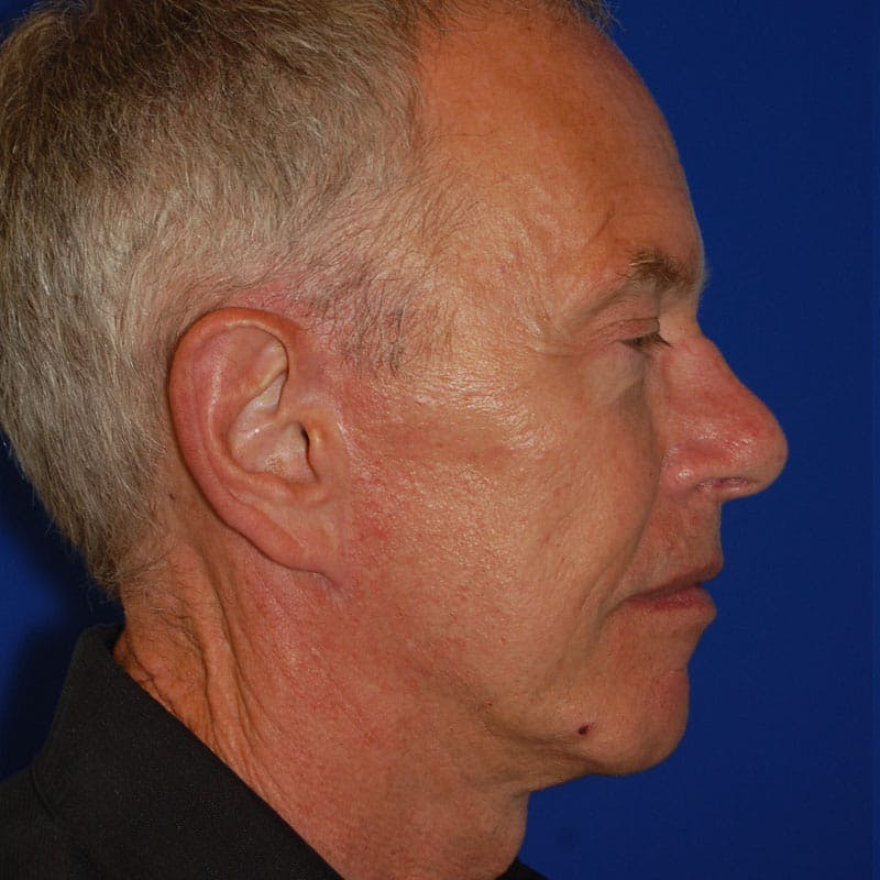 Facelift & Necklift Before & After Gallery - Patient 194480 - Image 6