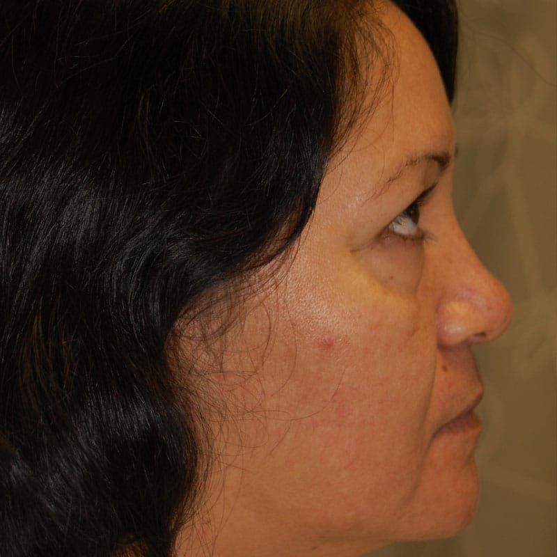 Lower Eyelid Surgery Before & After Gallery - Patient 195367 - Image 5