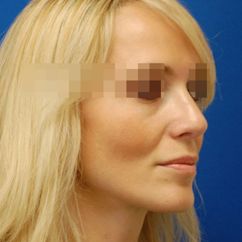 Revision Rhinoplasty Before & After Gallery - Patient 183705 - Image 6