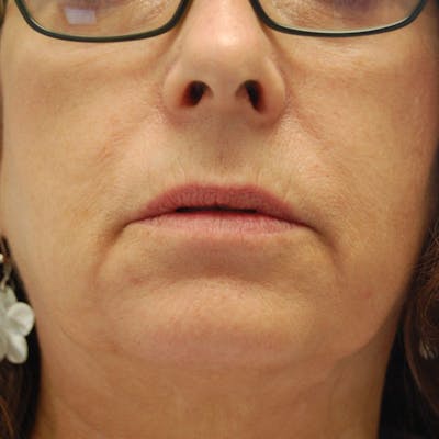 Lip Augmentation Before & After Gallery - Patient 894534 - Image 1