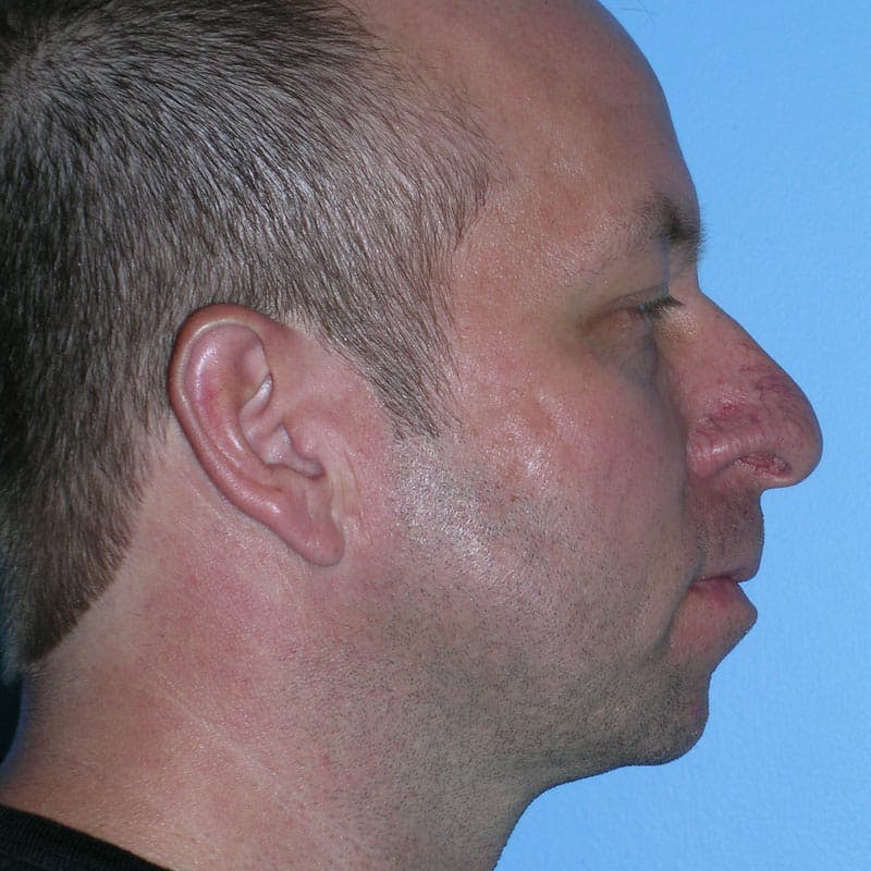 Chin Augmentation Before & After Gallery - Patient 220035 - Image 5