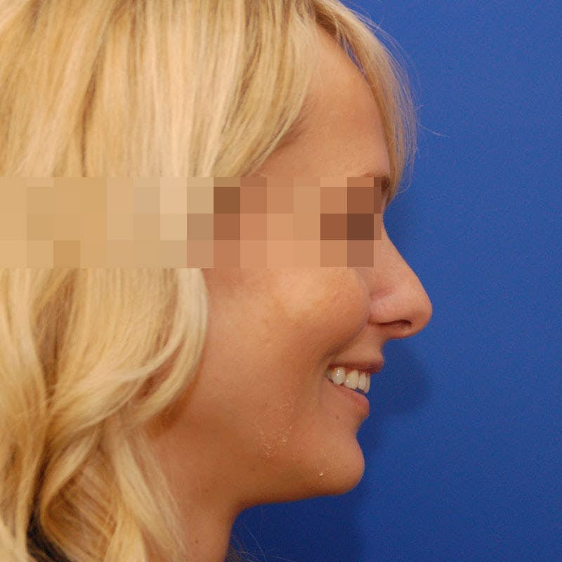 Revision Rhinoplasty Before & After Gallery - Patient 183705 - Image 5
