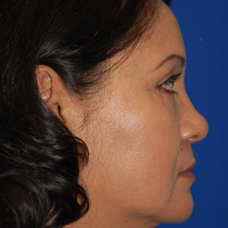 Lower Eyelid Surgery Before & After Gallery - Patient 195367 - Image 6