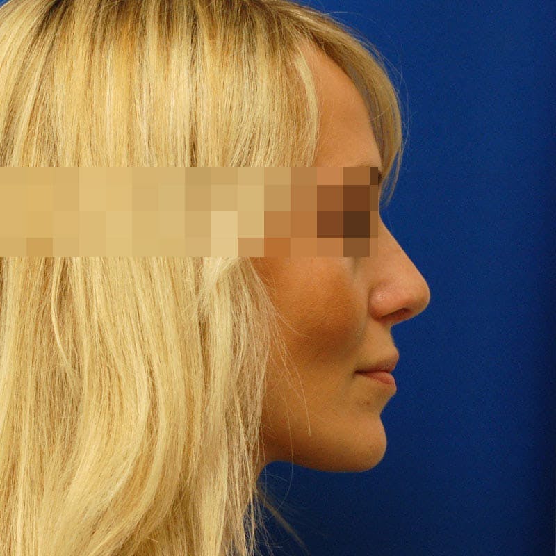 Revision Rhinoplasty Before & After Gallery - Patient 183705 - Image 2