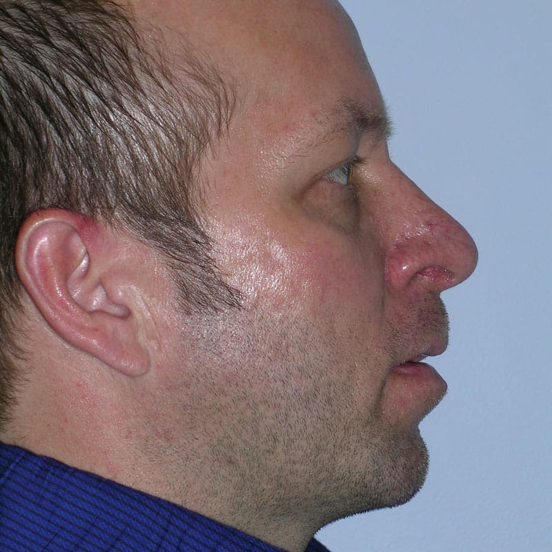 Chin Augmentation Before & After Gallery - Patient 220035 - Image 6