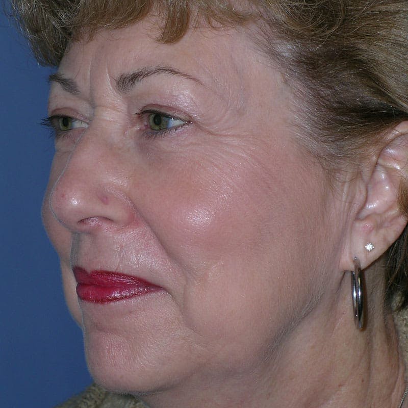Facelift & Necklift Before & After Gallery - Patient 346696 - Image 3