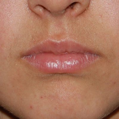 Lip Augmentation Before & After Gallery - Patient 244609 - Image 2