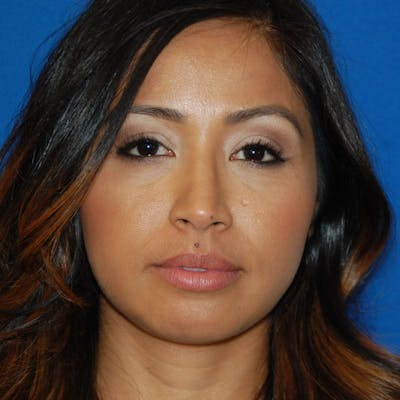 Chin Augmentation Before & After Gallery - Patient 425914 - Image 2