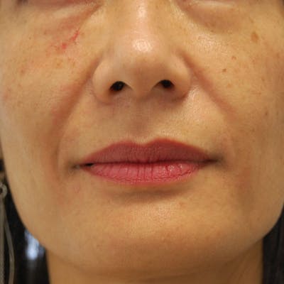 Lip Augmentation Before & After Gallery - Patient 358426 - Image 1